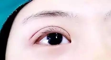 网红式双眼皮